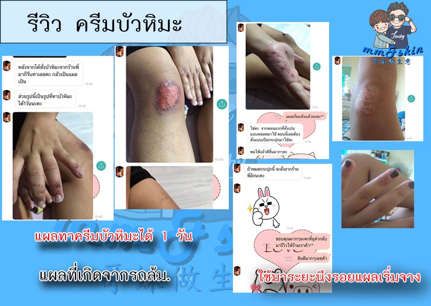 รีวิวครีมบัวหิมะ-รักษาแผลรถล้ม-แผลเกิดจากการถลอก
